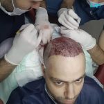 زراعة الشعر في تركيا