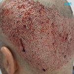 زراعة الشعر في تركيا