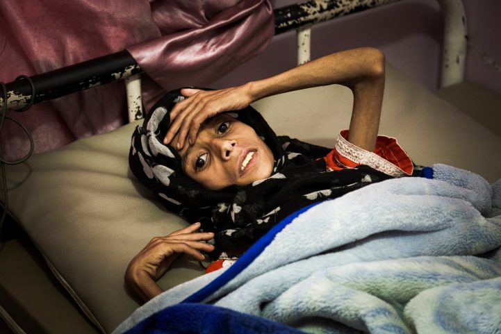 ساديا إبراهيم محمود ، 11 عامًا ، في قسم سوء التغذية في مستشفى السبين للنساء والأطفال/ الغارديان