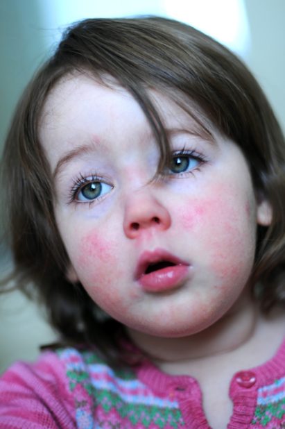 istock احمرار الوجه