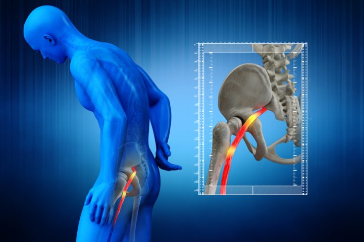 iStock/ عرق النسا