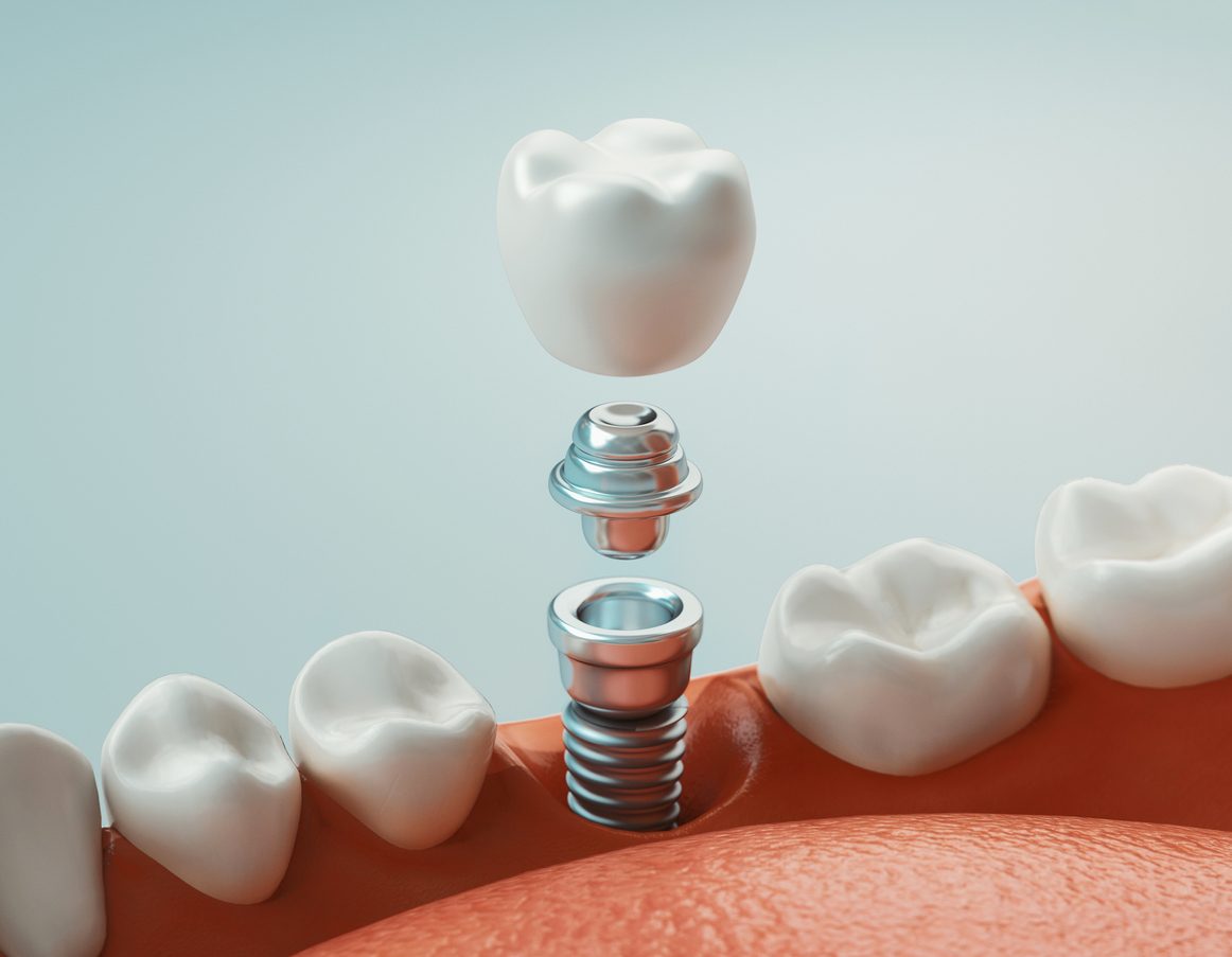 زراعة الأسنان iStock