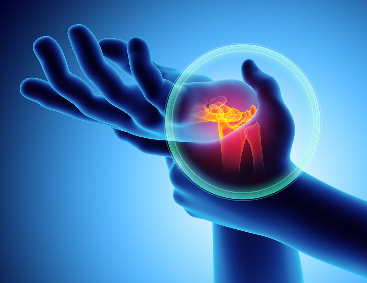 iStock/ متلازمة النفق الرسغي