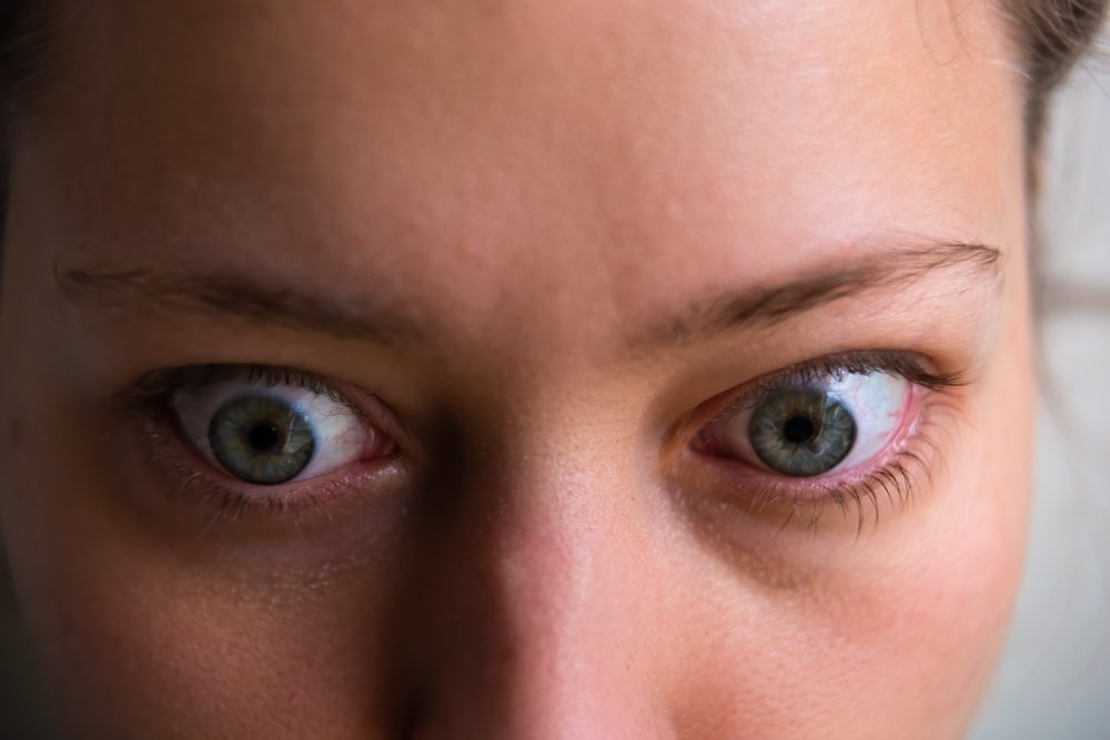 ألمُ في الجفون وجحوظ في العينين.. انتبه لأعراض داء “جريفز” الذي يسببه فرط نشاط الغدة الدرقية