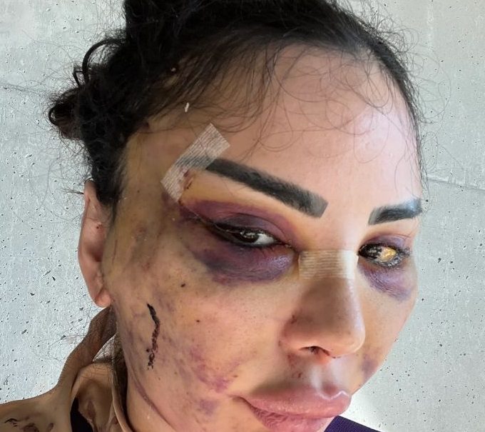 عارضة الأزياء بعد إجراء عمليات جراحية لتعود لمظهرها الحقيقي - Caters News Agency