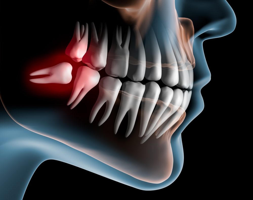 ضروس العقل قد تؤثر على باقي الأسنان / Shutterstock
