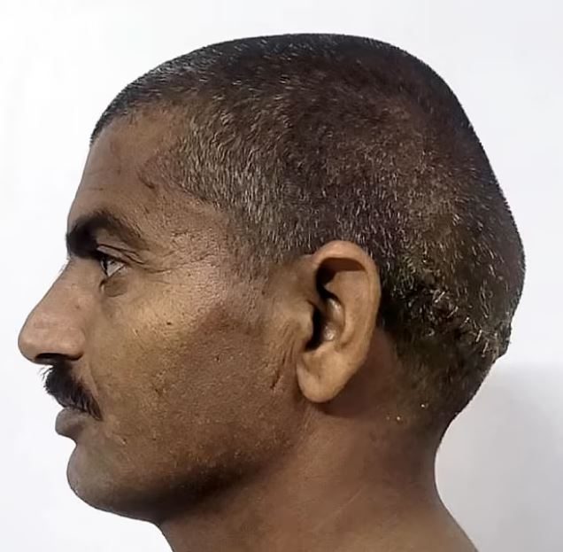 صورة لرأس الرجل بعد الجراحة